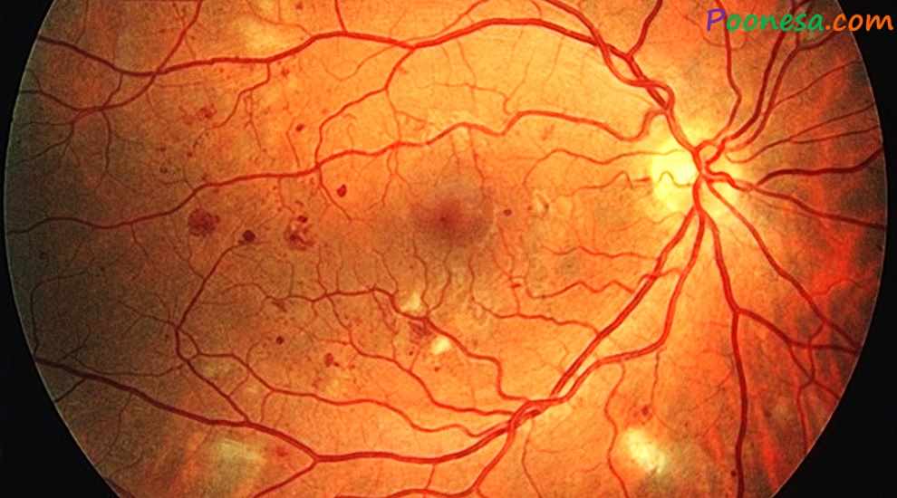 رتينوپاتي شایع‌ترین علت از دست دادن بینایی در بیماران مبتلا به دیابت و همچنین بیماران قلبی عروقی می‌باشد. 